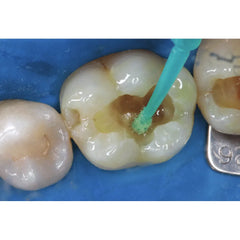 Spident EsBond 5th Generation Bonding Agent