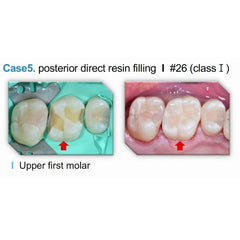 Spident EsCom250 NanoHybrid Composite System Kit