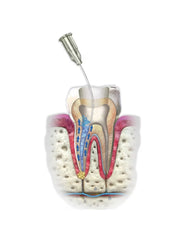 Neoendo NeoEDTA Gel EDTA (Chelating Agent)